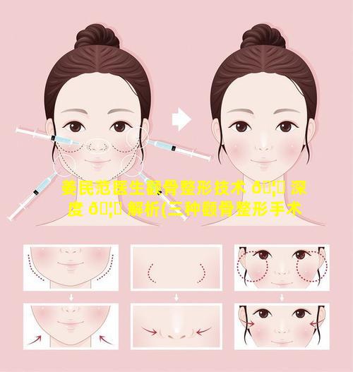 姜民范医生颧骨整形技术 🦁 深度 🦋 解析(三种颧骨整形手术方法对比)